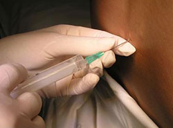 Виды анестезии при операциях паховой грыжи