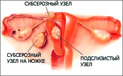 Эндоскопическая операция по удалению миомы матки thumbnail