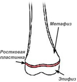 Эпифизеолиз переломы