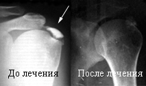 Надостной мышцы бурсит