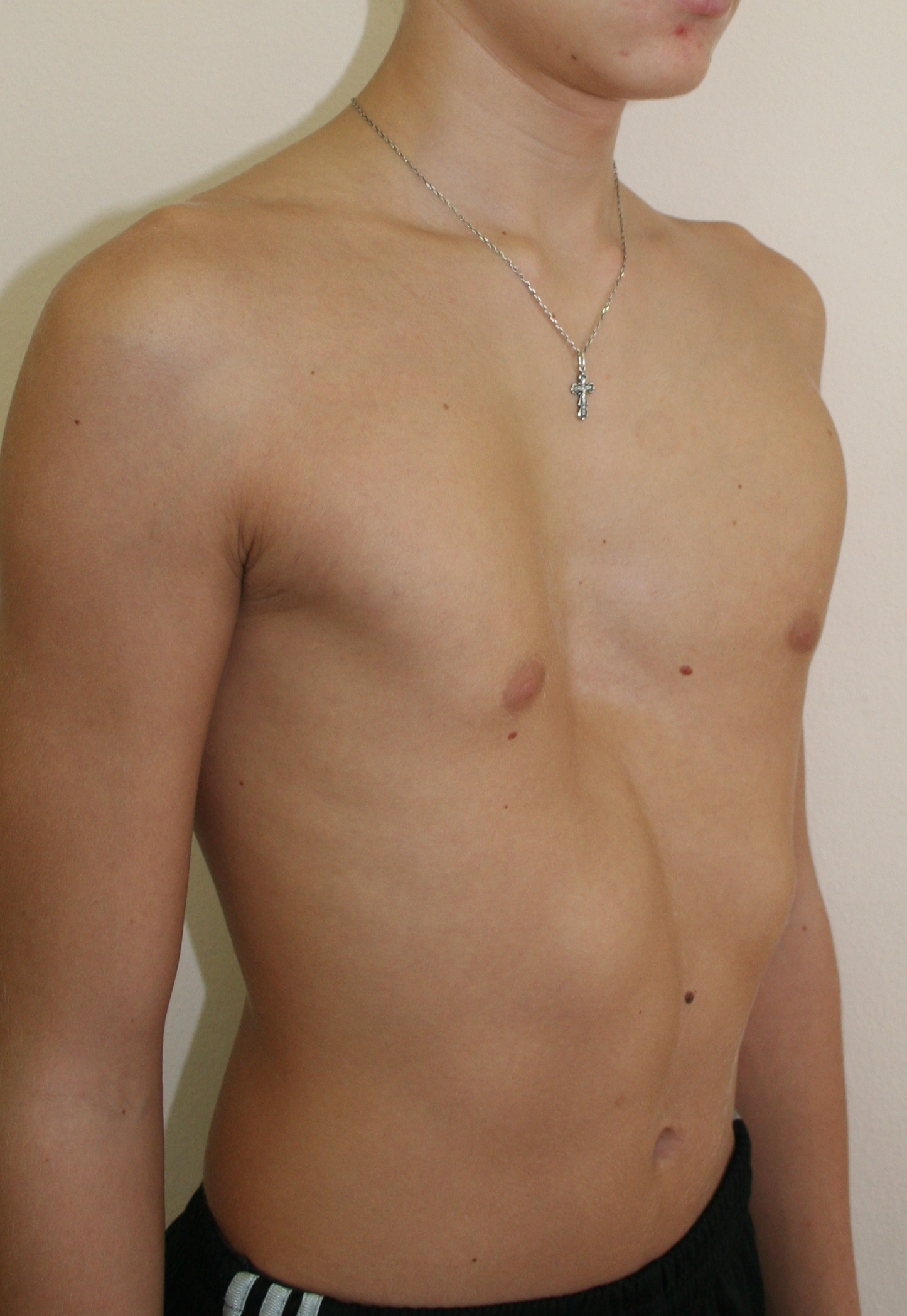 воронкообразная грудь у мужчин (120) фото