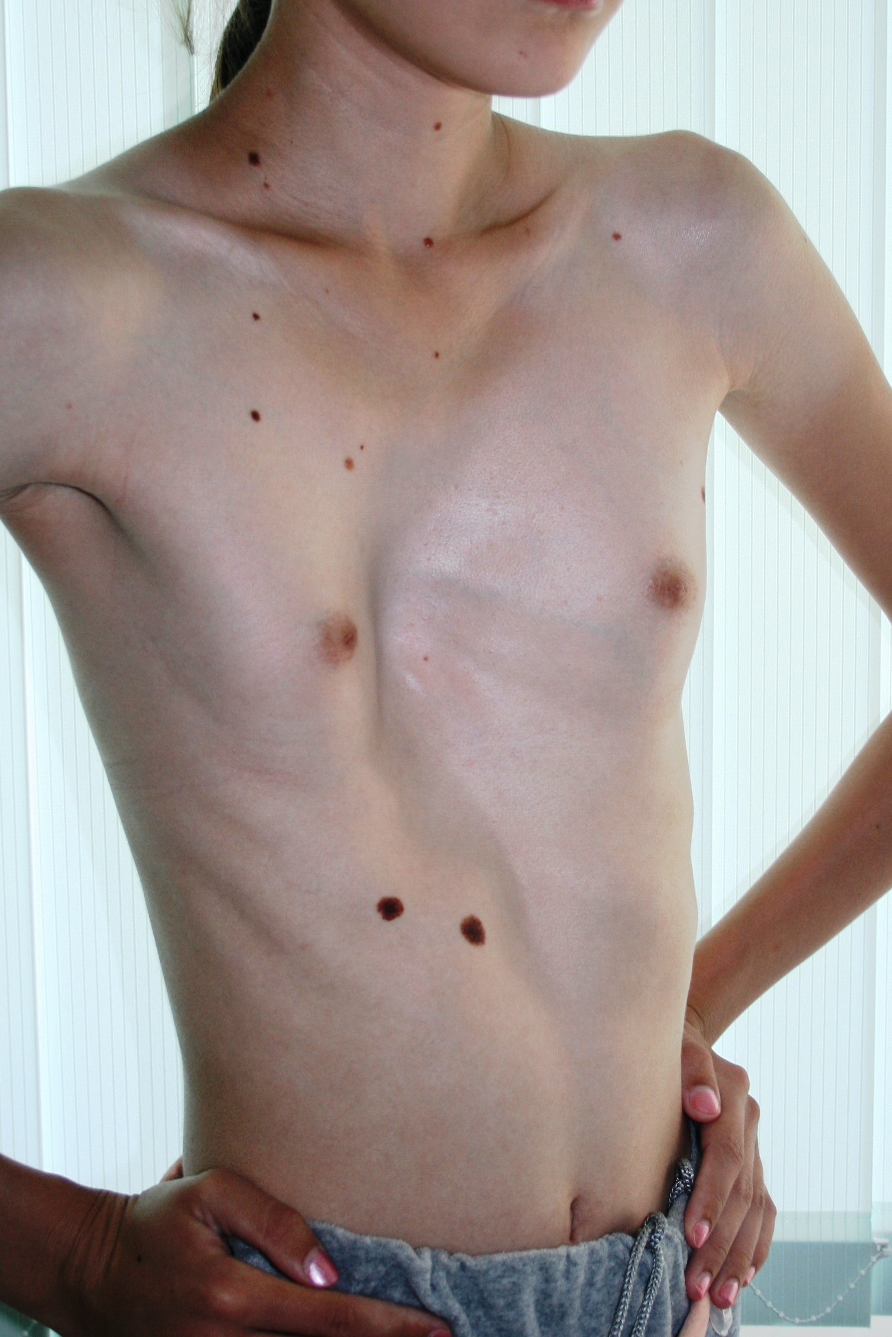 воронкообразная грудь у мужчин фото 108